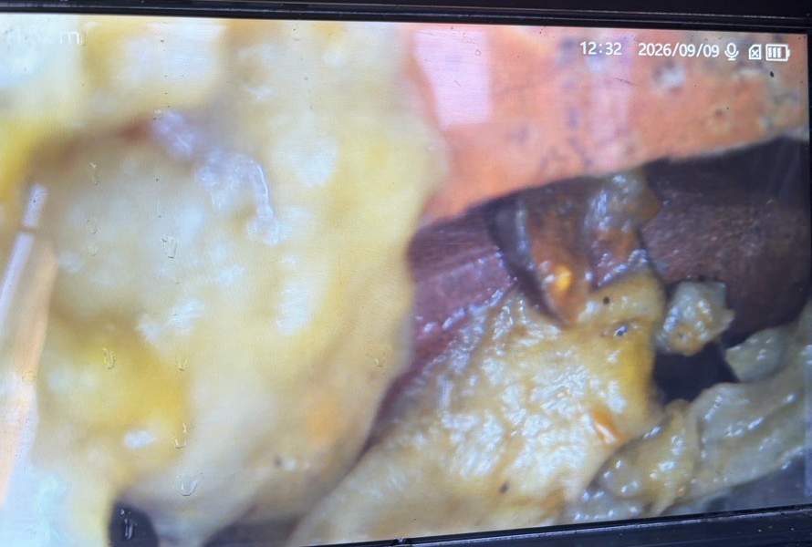 Drain camera view of a toilet paper blockage packed inside a sewer pipe